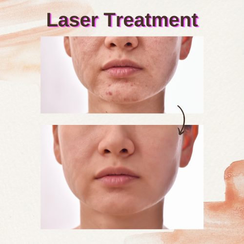 Laser Treatment